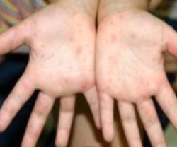 手足口病は子供のだけの病気ではない？大人が感染すると重症化？